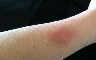 Does your kettlebell clean bruise your forearm?